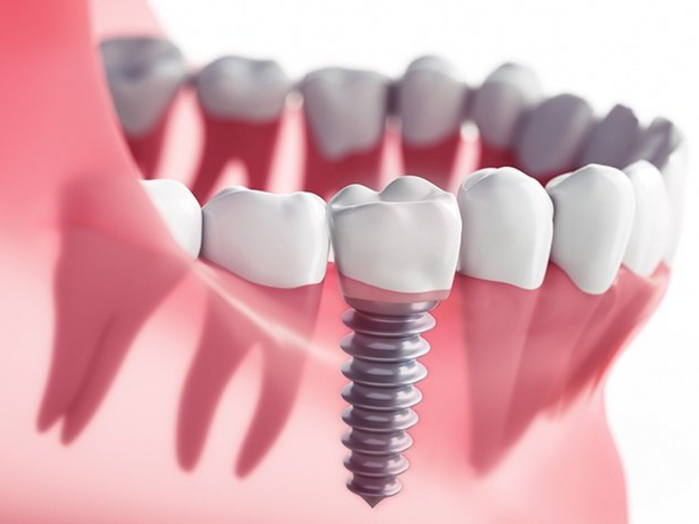 What to Do If Your Dental Implants Fail